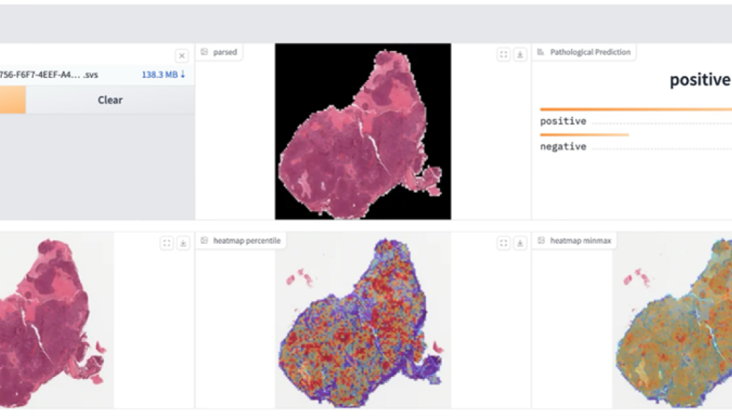 Histopatologiska bilder kan analyseras och visualiseras med Exaone Path för att identifiera möjliga genetiska förändringar i celler. Färgvariationer kan ge viktiga ledtrådar om potentiella genetiska förändringar eller abnormiteter i cellerna. Bild: LG AI Research